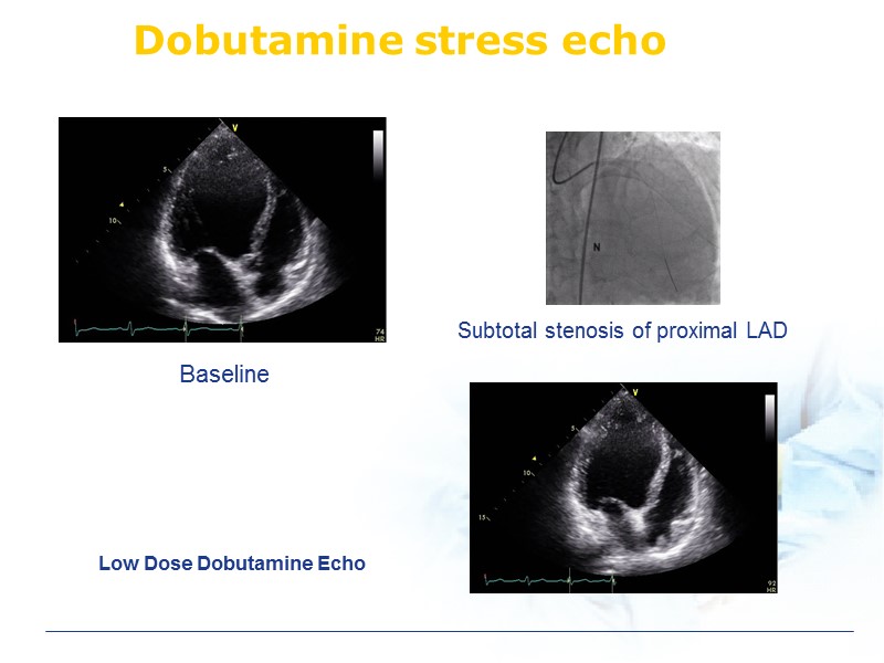 Dobutamine stress echo Low Dose Dobutamine Echo Baseline Subtotal stenosis of proximal LAD